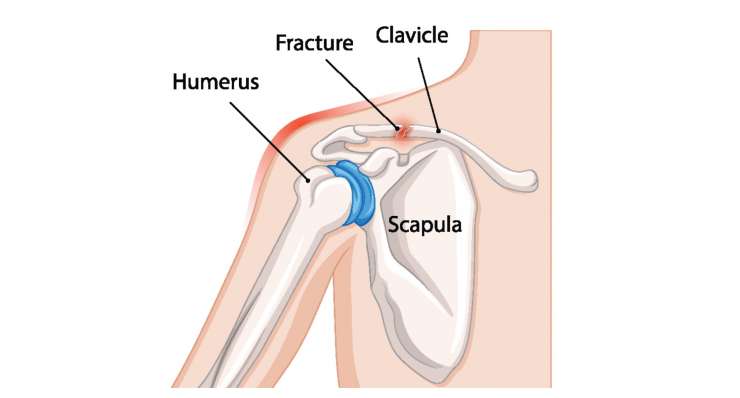 Fraktur des Schultergürtels Fraktur des Schultergürtels. Behandlung in München durch Prof. Dr. med. Martetschläger