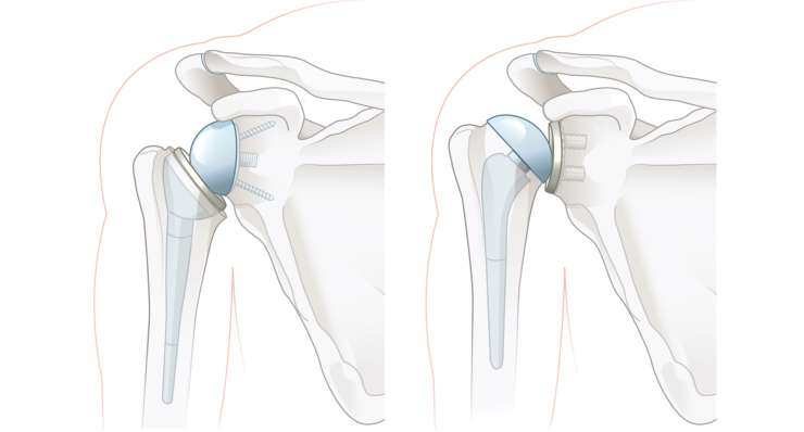 Schulterarthrose (Ormarthrose) Schulterarthrose (Ormarthrose). Behandlung in München durch Prof. Dr. med. Martetschläger
