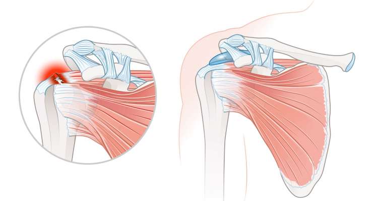 Verletzung der Rotatorenmanschette Verletzung der Rotatorenmanschette - Schmerzen und Funktionsverlust der Schulter. Behandlung in München durch Prof. Dr. med. Martetschläger